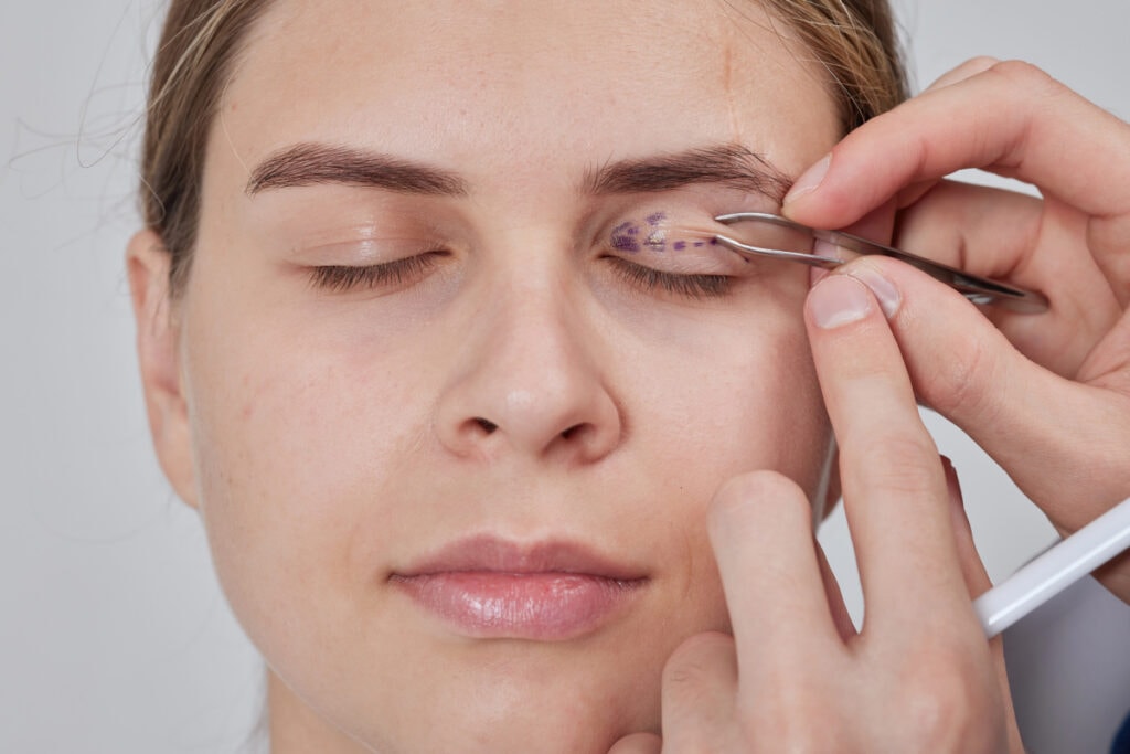 eyelift surgery