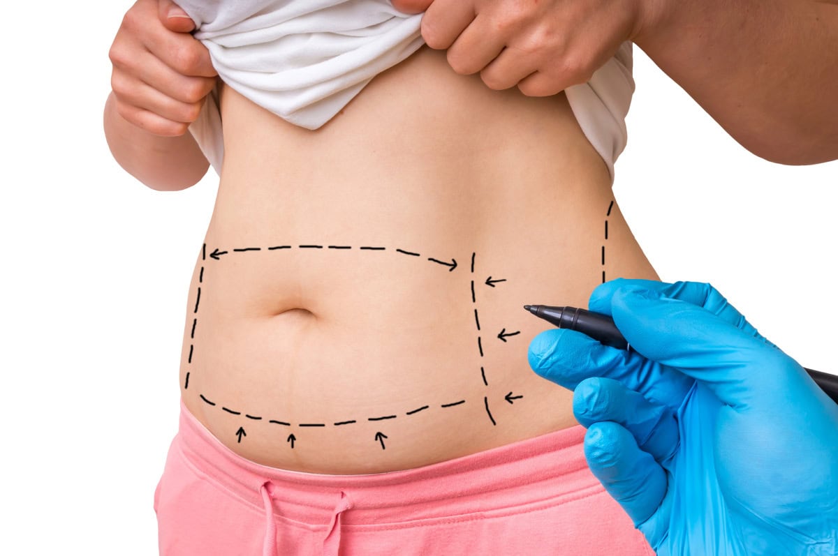 facts about liposuction