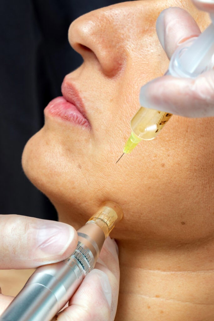 microneedling results